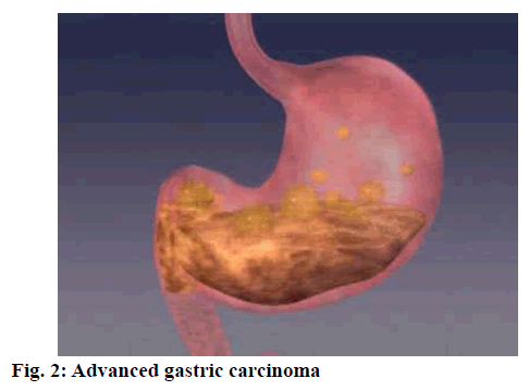 ijpsonline-gastric-carcinoma
