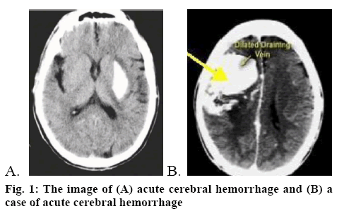 ijpsonline-hemorrhage