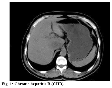 ijpsonline-hepatitis