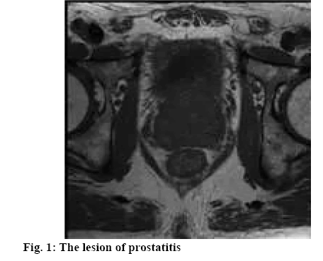 ijpsonline-lesion