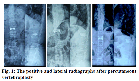 ijpsonline-percutaneous