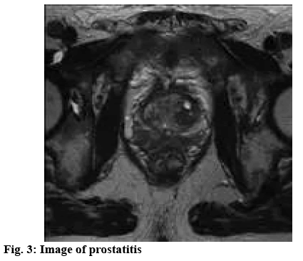 ijpsonline-prostatitis