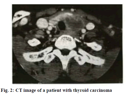 ijpsonline-thyroid