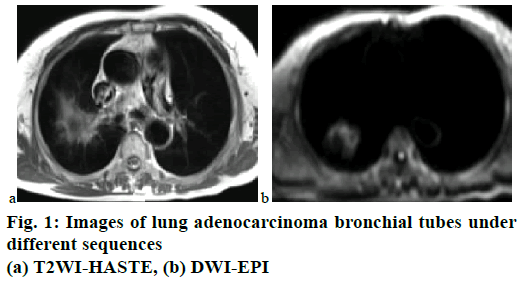 pharmaceutical-sciences-lung-adenocarcinoma