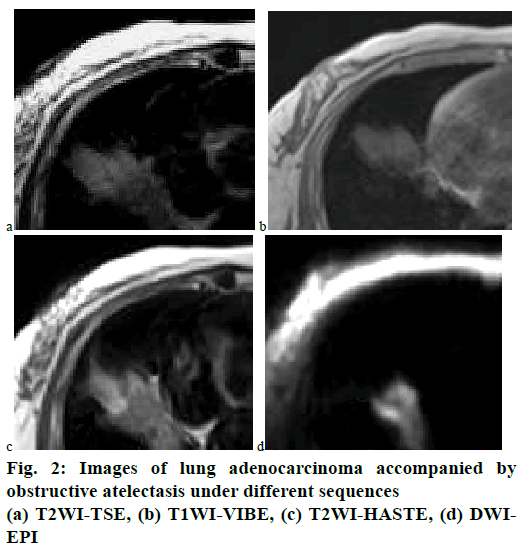 pharmaceutical-sciences-lung-adenocarcinoma